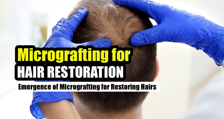 Micrografting for Hair Restoration