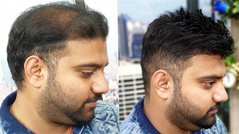 Could Non-Surgical Hair Replacement Correct Baldness in Dubai?