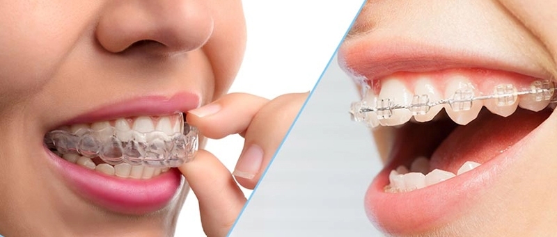 Invisalign vs traditional braces